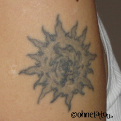 Tattoo entfernen mit Laserbehandlung