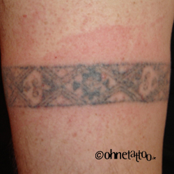 Tattoo entfernen mit Laserbehandlung